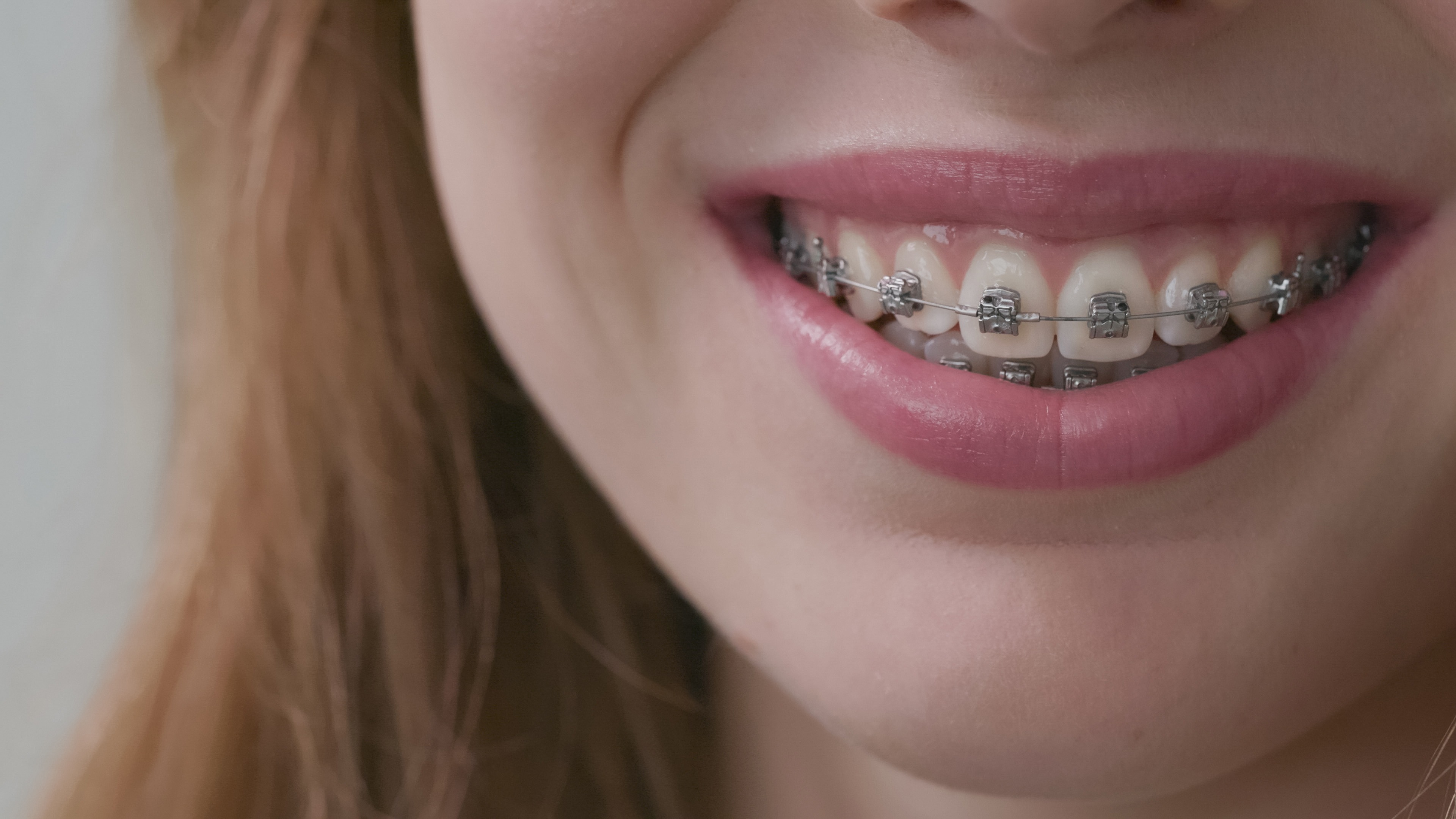 Carriere SLX Model - 00020_brighter Carriere braces