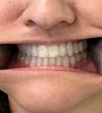 Bee Cave Orthodontics Invisalign Appointment Front