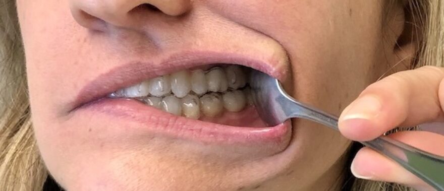 Use the spoon on your mouth left side to show your Invisalign on the left